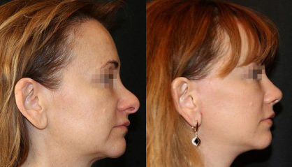Rhinoplastyのビフォーアフター