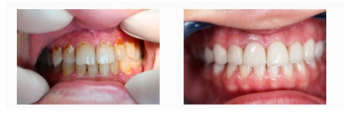 Dental Dynastiaで装着されたベニア 